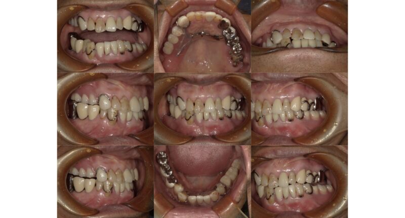 インプラント治療が必要なくなった症例